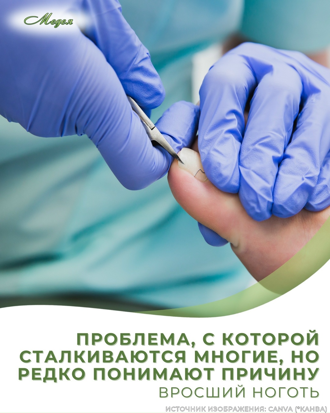 Вросший ноготь